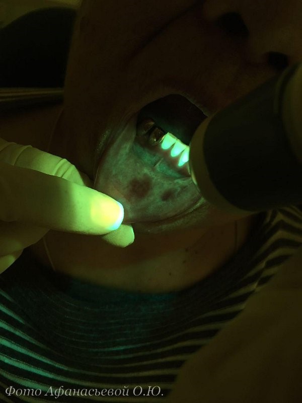 Аутофлуоресцентная стоматоскопия