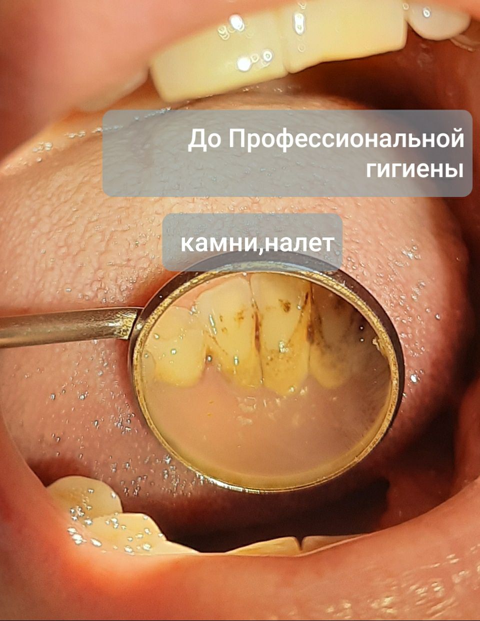 Гигиена полости рта. Фото до процедуры