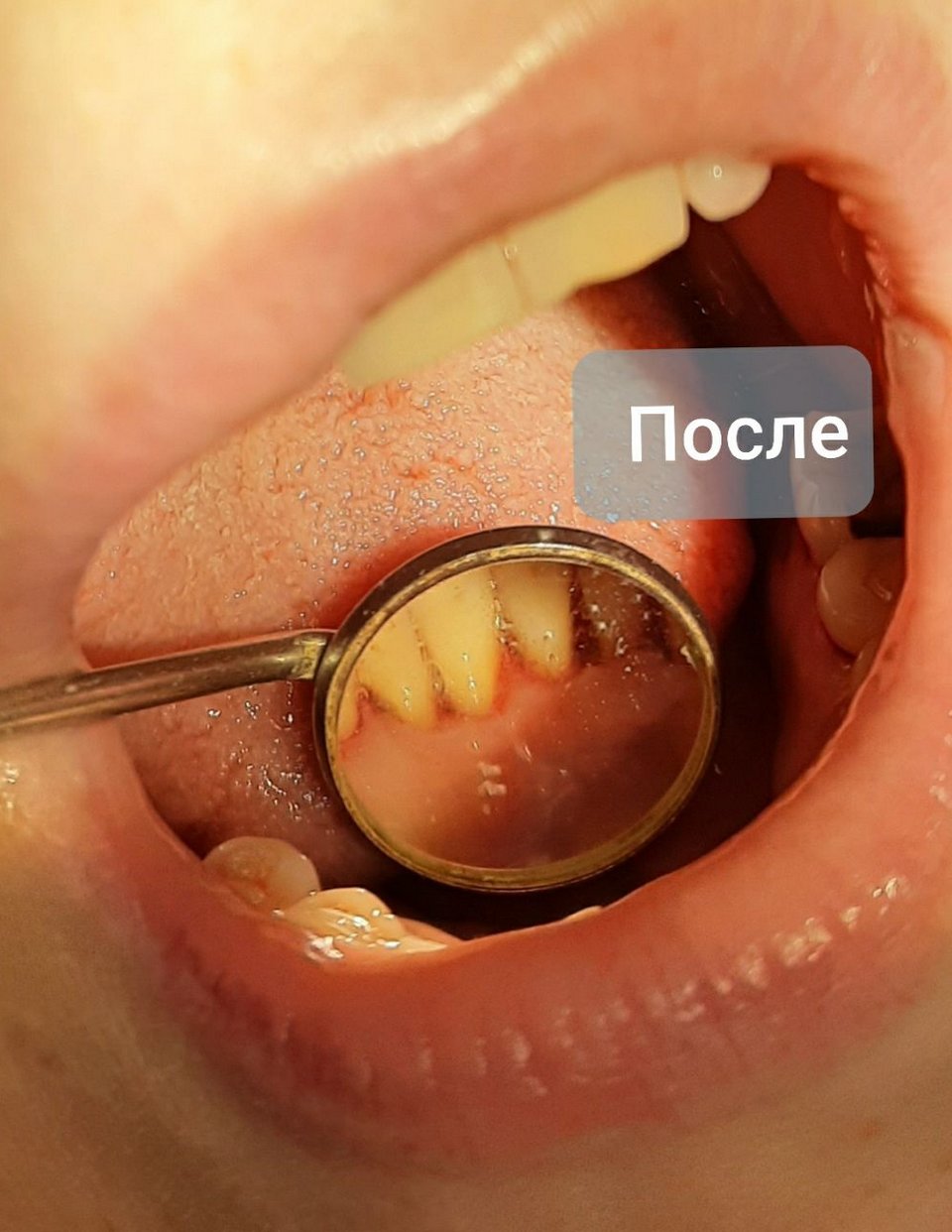 Гигиена полости рта. Фото после процедуры