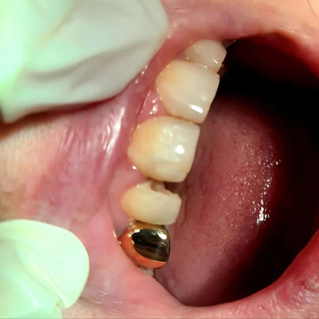 Реставрация переднего зуба. До лечения.