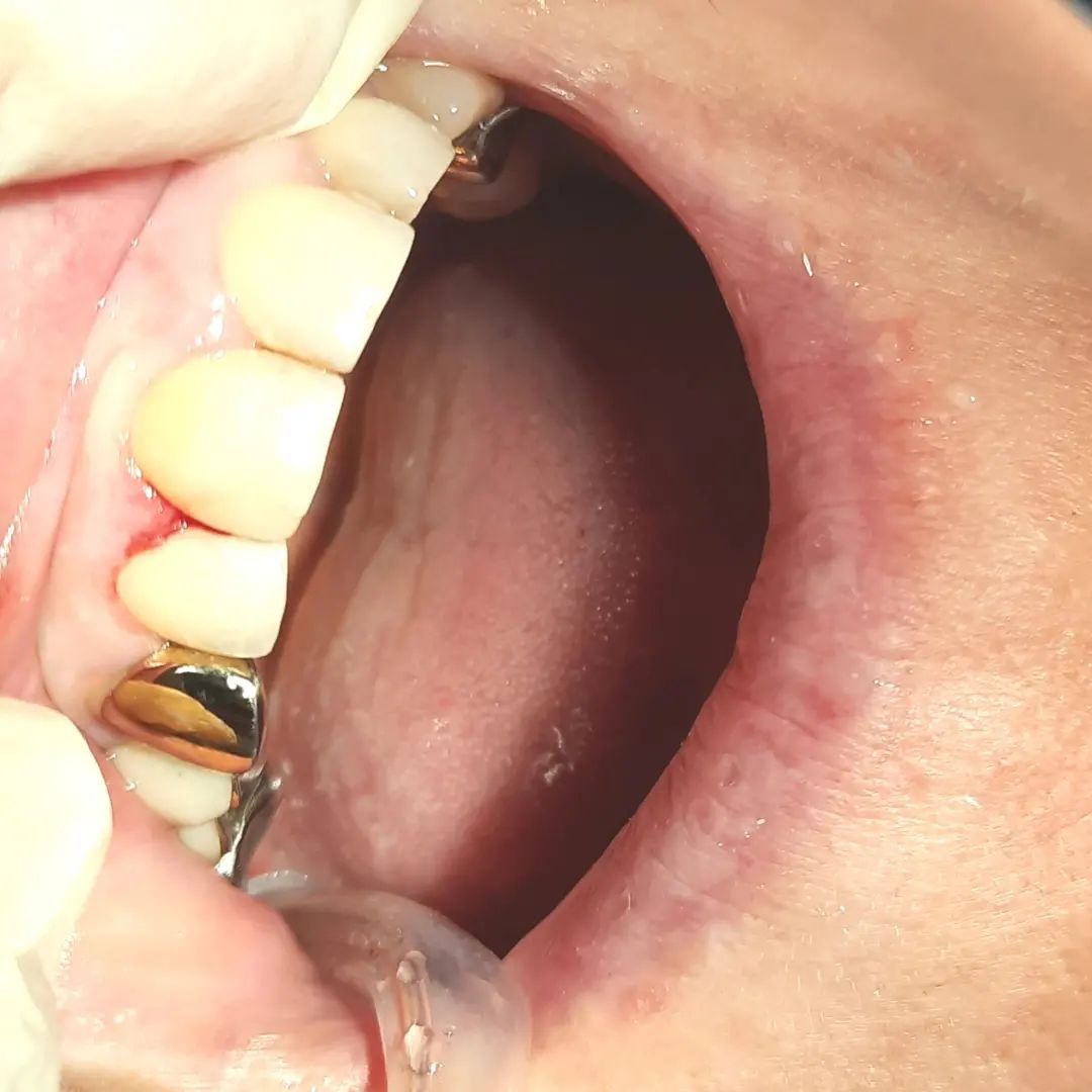 Реставрация переднего зуба. После лечения.